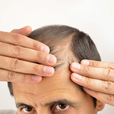 Effective Natural Remedies to Prevent Hair Loss