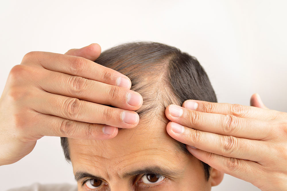 Effective Natural Remedies to Prevent Hair Loss