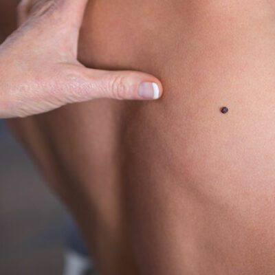 Prevention, Symptoms and Treatment Options for Melanoma