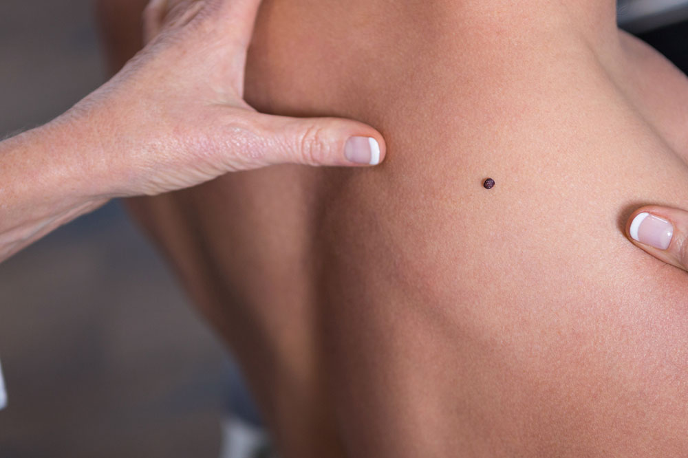 Prevention, Symptoms and Treatment Options for Melanoma