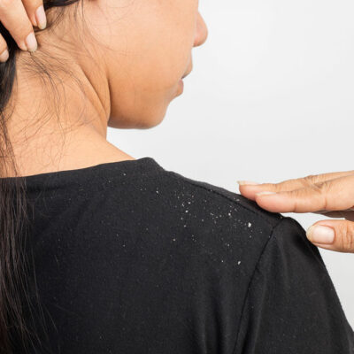 Top 5 Natural Ways to Get Rid of Dandruff