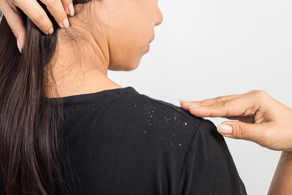 Top 5 Natural Ways to Get Rid of Dandruff