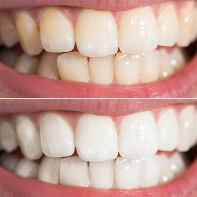 Whiten Your Teeth with These Natural Tips