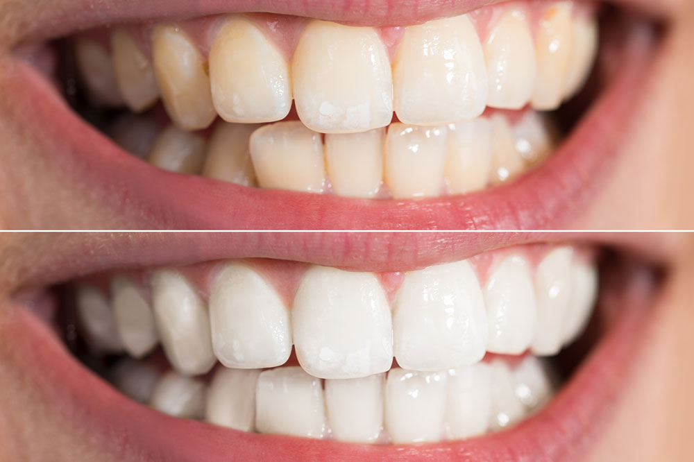 Whiten Your Teeth with These Natural Tips